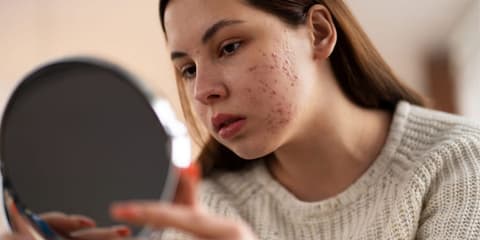 Manchas de Espinha: Por Que Aparecem e Como Prevenir Novas Marcas